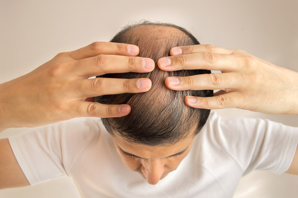 הידלדלות שיער – הגורמים לתופעה