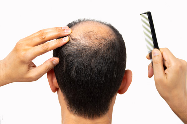 שיער דליל – דרכי טיפול